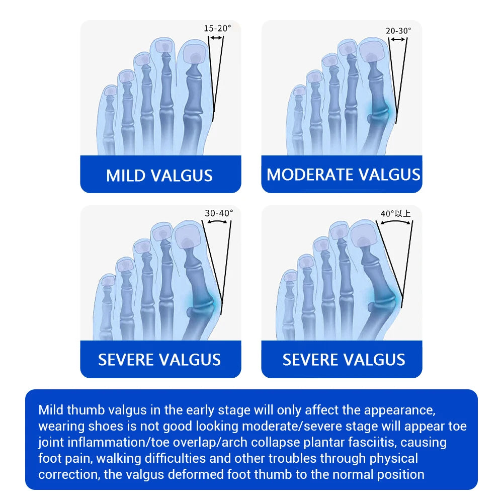 Bunion Adjuster Brace Big Toe Straightener with Knob Dial for Pain Relief and Natural Alignment