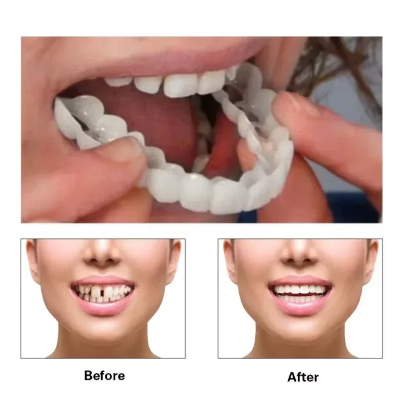 Veneer Snap on Teeth Kit Temporary Tooth Replacement Cosmetic Cover for Smile