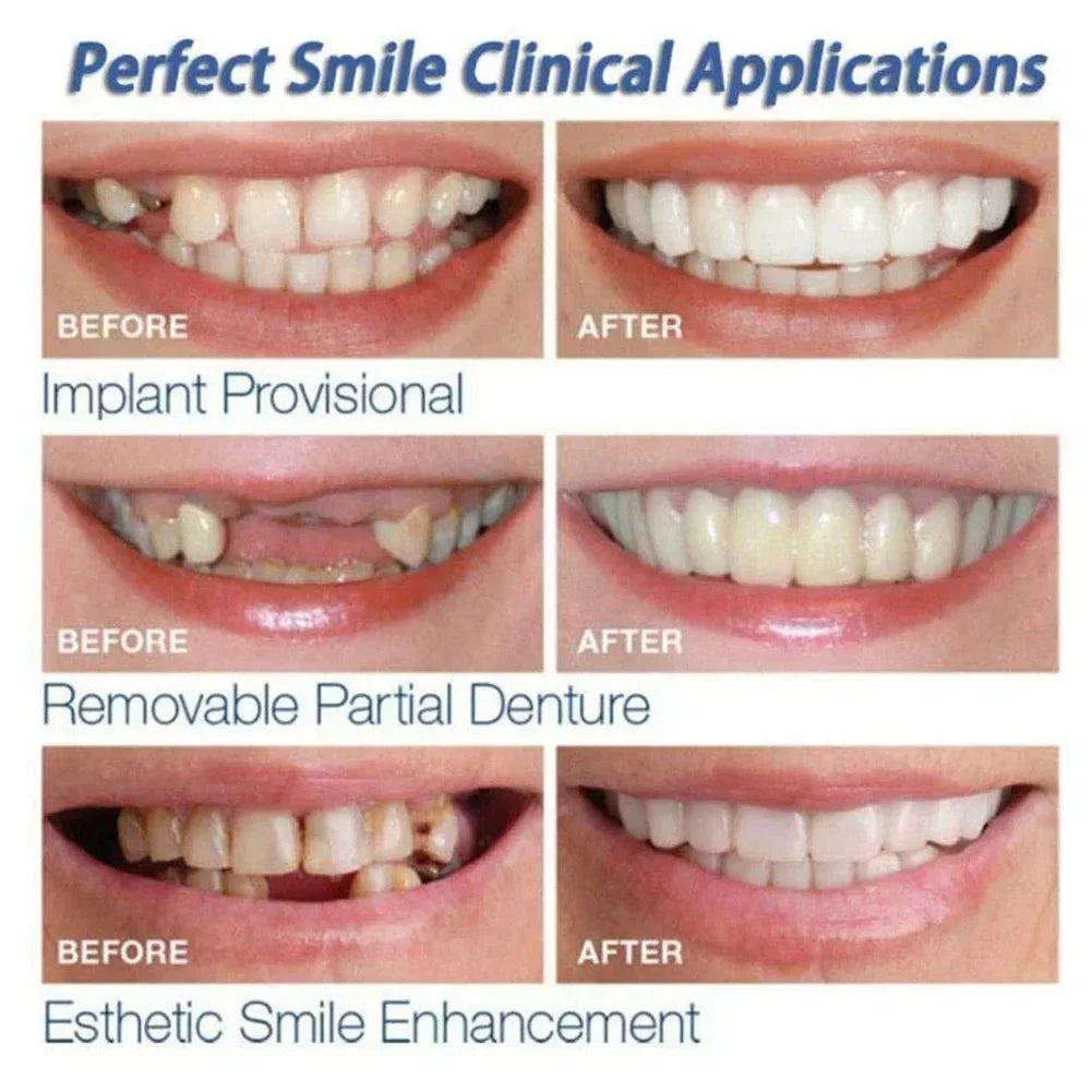 Veneer Snap on Teeth Kit Temporary Tooth Replacement Cosmetic Cover for Smile - 3